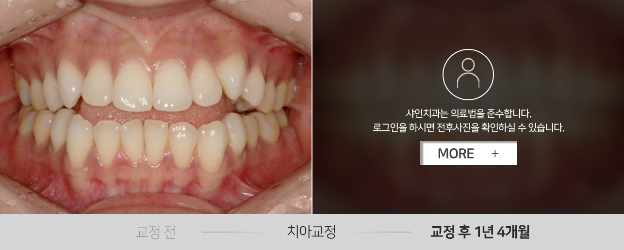 치아교정-전후사진2